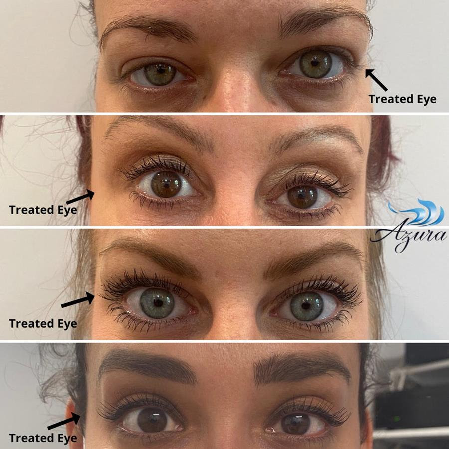 Upneeq® at Azura Skin Care Center in Cary